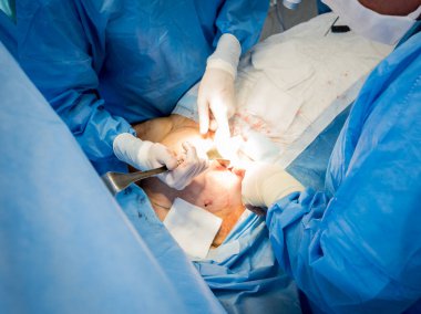 Göğüs kafesini çıkarıp yerine implant takmak için ameliyat..