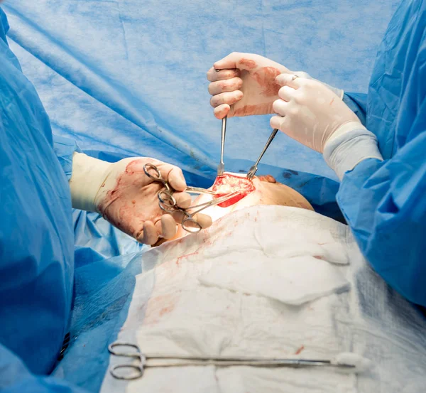 Operacja usunięcia piersi i zastąpienia jej implantem. — Zdjęcie stockowe