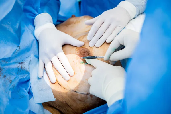 Chirurgia per rimuovere il seno e sostituirlo con un impianto. — Foto Stock
