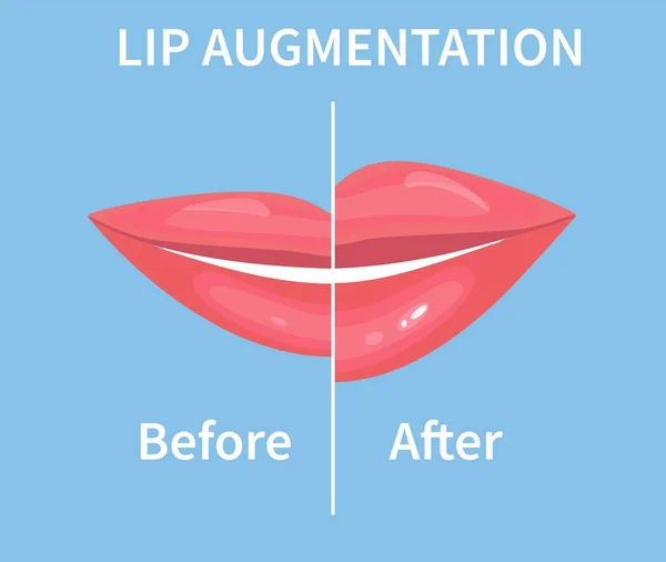 Lippenvergrößerung. vor und nach Lippenfüllungsinjektionen. Vektorillustration — Stockvektor