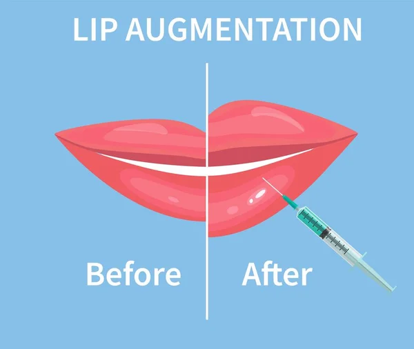 Aumento de labios. Antes y después de las inyecciones de relleno labial. Ilustración vectorial — Archivo Imágenes Vectoriales