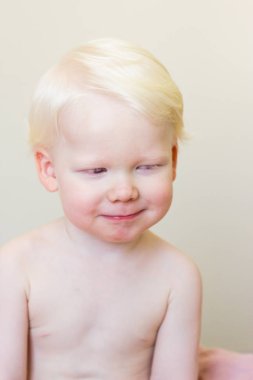 Whitehair babyboy with albinism syndrome on white clipart