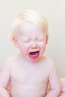 Whitehair babyboy beyaz albinizm sendromlu