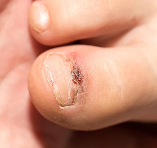 Dedo da perna ferida — Fotografia de Stock