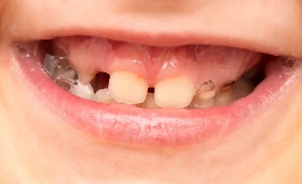 Mléčné zuby v ústech — Stock fotografie