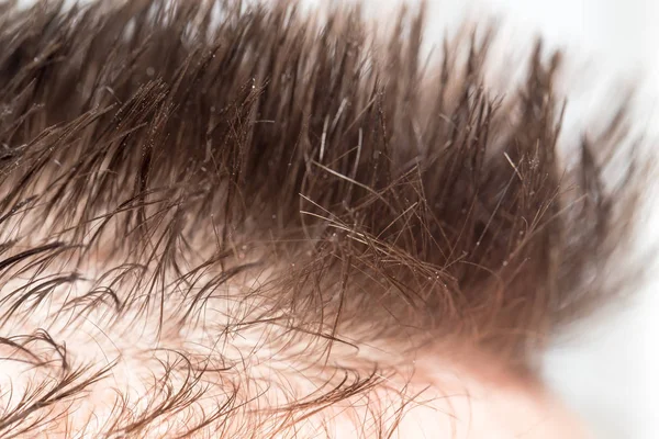 Haare auf dem Kopf eines Mannes. schließen — Stockfoto