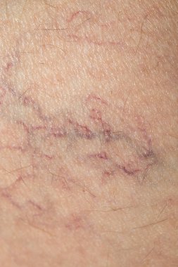 damarlar cilt üzerinde. Kapat