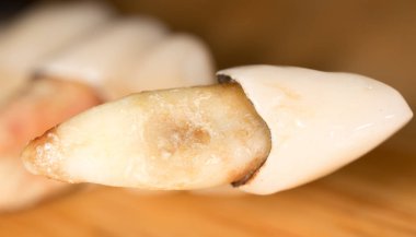 Diş parçalanmış. Makro