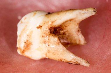 Diş parçalanmış. Makro