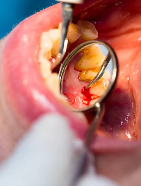 Tratamento dentário em odontologia — Fotografia de Stock