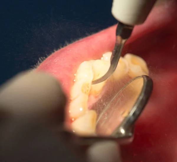 Tratamento dentário em odontologia — Fotografia de Stock