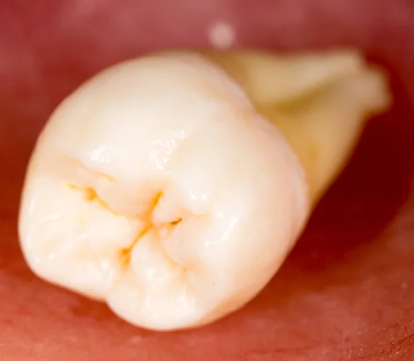 Зуб вырван. macro — стоковое фото