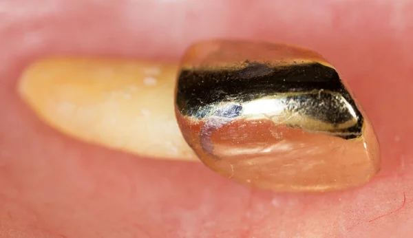Металлический зуб. macro — стоковое фото