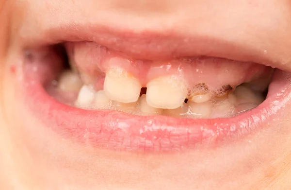 Dentes de leite na boca — Fotografia de Stock