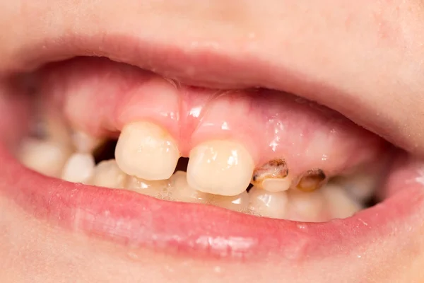 Dents de bébé dans la bouche — Photo
