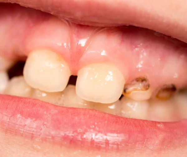 Детские зубы во рту — стоковое фото