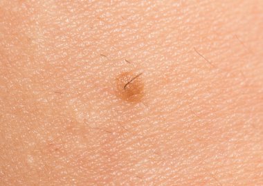 Doğum lekesi cilt üzerinde. Kapat