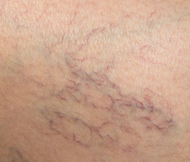 damarlar cilt üzerinde. Kapat