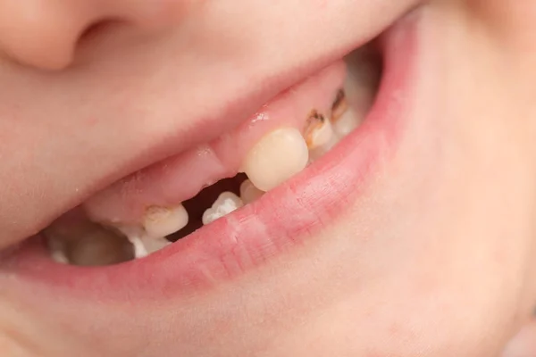 Dientes en los niños. primer plano — Foto de Stock