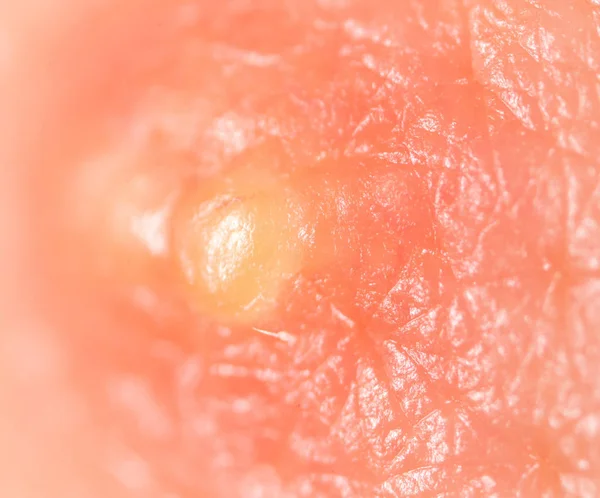 Pimple on the skin. macro — Stock Photo, Image