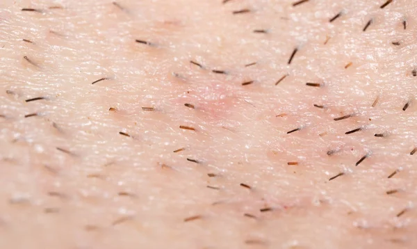 Le setole sulla pelle. macro — Foto Stock