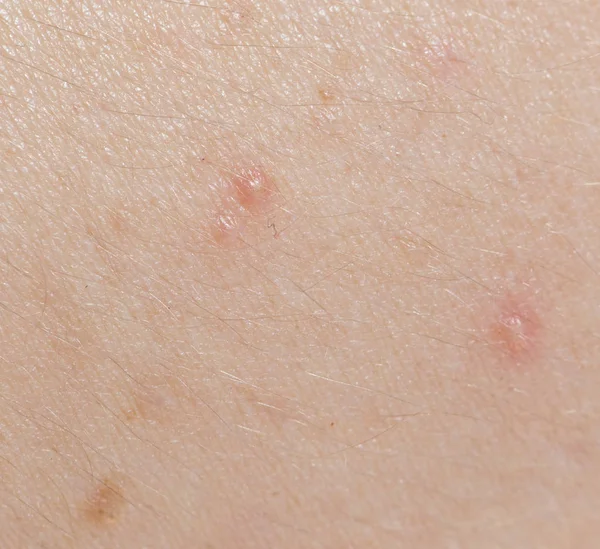 Pimples on the skin. close — Stock Photo, Image