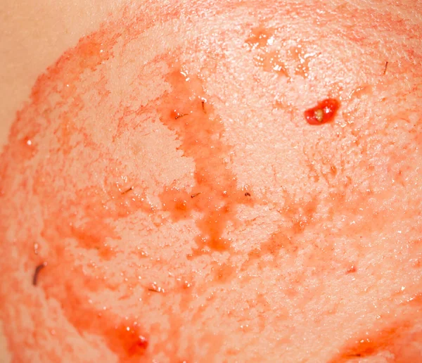 Strawberries Face Spa — Stock Photo, Image