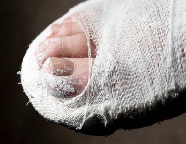 Siyah arkaplanda alçıdan bir bacak. .