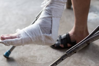 Alçılı bir erkekte kırık bacak. Doğadaki parkta.