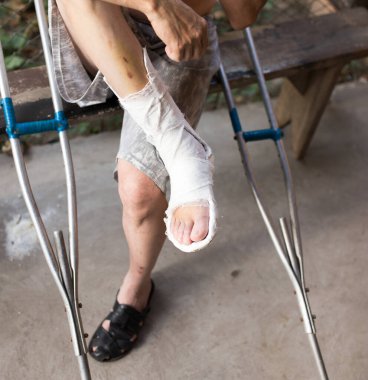 Alçılı bir erkekte kırık bacak. Doğadaki parkta.