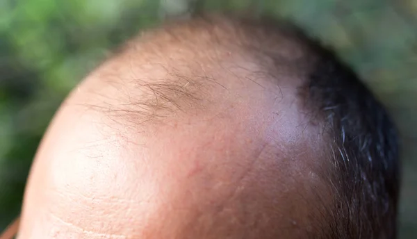 Pérdida Cabello Cabeza Hombre —  Fotos de Stock