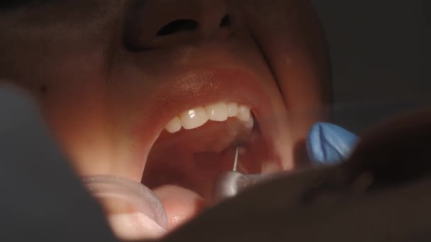 Dentista haciendo un tratamiento dental en una paciente femenina. — Vídeos de Stock