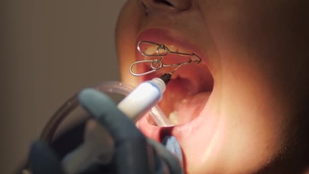 Dentista fazendo um tratamento odontológico em uma paciente do sexo feminino. — Vídeo de Stock