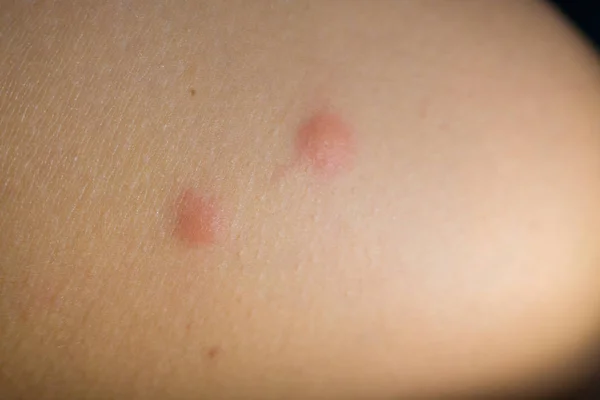 Insect bites on female hand — Stock Photo, Image