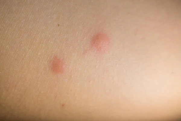 Insect bites on female hand — Stock Photo, Image