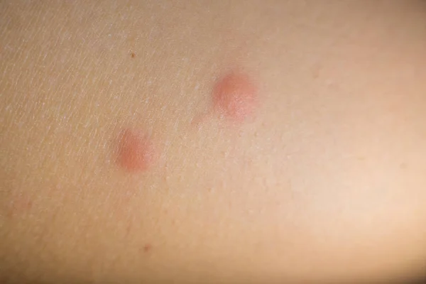 Insect bites on female hand — Stock Photo, Image