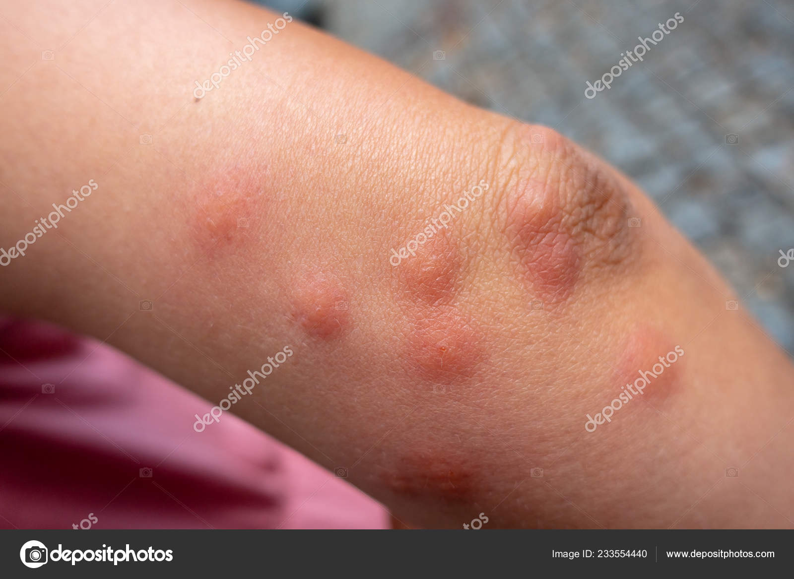 Cientista identifica primeiro caso de morte causada por alergia a carne –  Noticias R7, image size:1600x1167