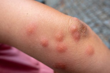 Insect bites on female hand clipart