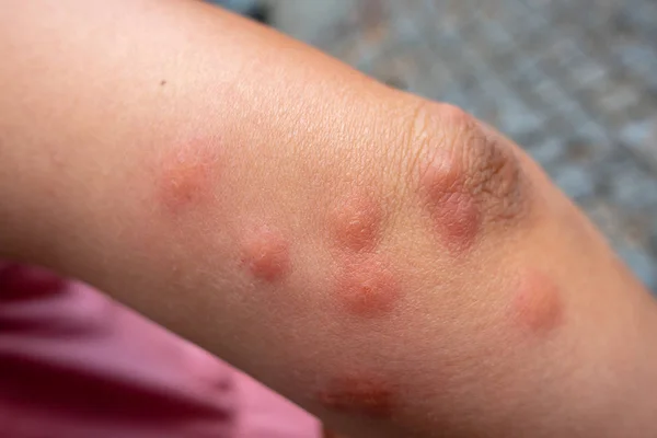 Insect bites on female hand — Stock Photo, Image