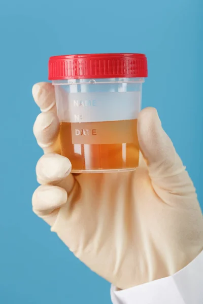 A container for biomaterial with a urine analysis in the hand of a doctor in a white rubber glove on a blue background. The concept of a health check. Free space.