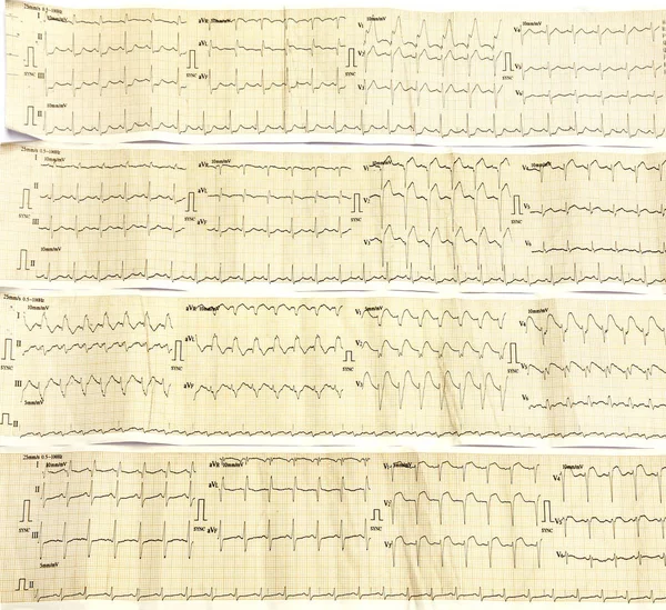 Electrocardiograph Close Image Background — Stock Photo, Image