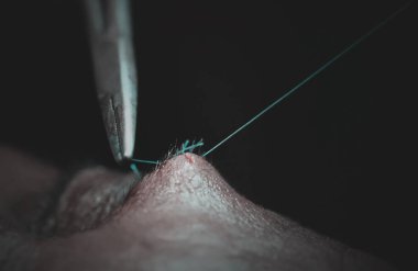 Alında cerrahi dikiş