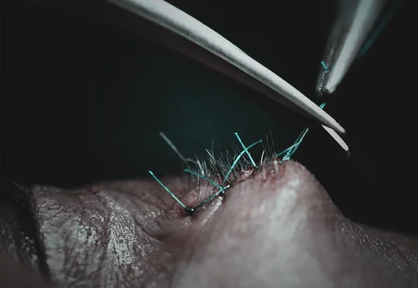 Surgical stitch in forehead