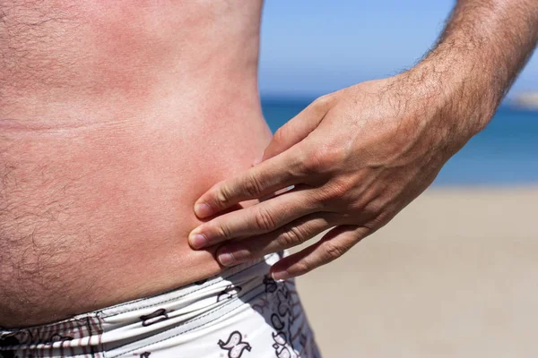 Mannelijk Lichaam Zomer Vakantie Zonnebrand Stockfoto