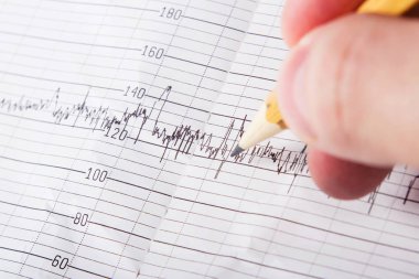 İnsan eli ve tıbbi grafik portre. Tıbbi geçmişi. Klinisyen veya hasta bir kardiyogram elinde tutuyor