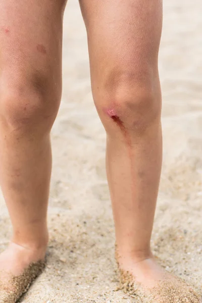 Las rodillas gastadas llevaban a un niño pequeño parado en la arena. La sangre proviene de una pequeña herida . — Foto de Stock