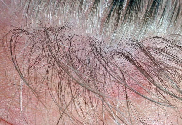 一个秃顶的老人头上有疼痛的油腻皮肤和稀疏的白发 工作室宏拍摄 — 图库照片