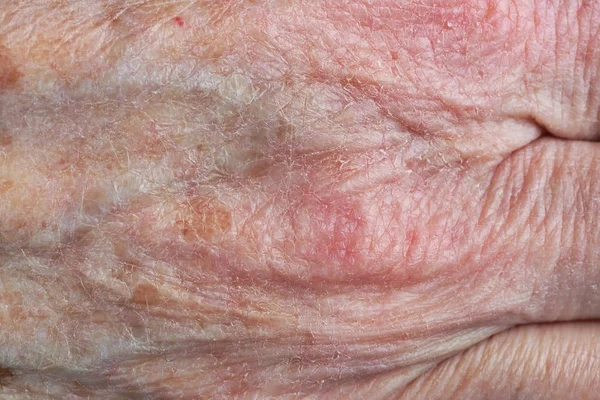 Sore Dry Skin Hand Old Woman Grandmother Studio Macro Shot — Stock Photo, Image
