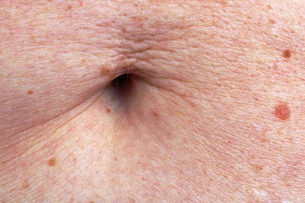 Surface Stomach Skin Navel Elderly Old Woman Lot Moles Blemishes — Stock Photo, Image
