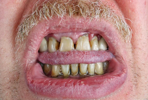 Dientes Amarillos Bigote Lengua Mordida Labios Secos Anciano Viejo Macro — Foto de Stock